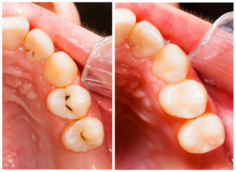 Dental Fillings